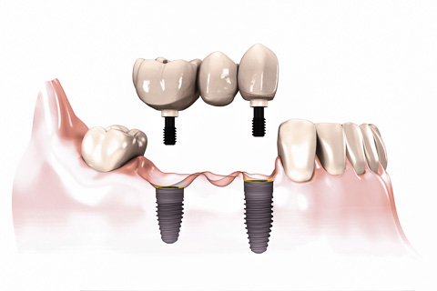 Screw Retained Bridge