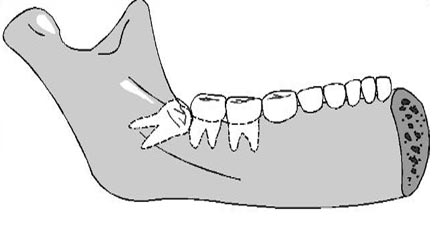 Impacted Tooth